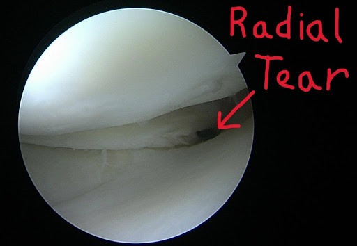 קרע רדיאלי של המניסקוס (כל הזכויות שמורות לליאור לבר®) Radial meniscus tear (All rights reserved to Lior Laver®)