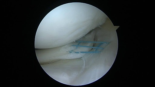 תפירה של קרע מניסקוס רדיאלי (כל הזכויות שמורות לליאור לבר®) Radial meniscus tear repair (All rights reserved to Lior Laver ®)
